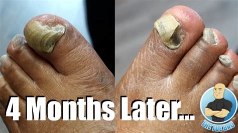 How To Get Rid Of Thick Toenails All You Need Infos