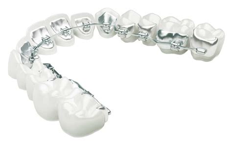Lingual Braces Inline Orthodontics