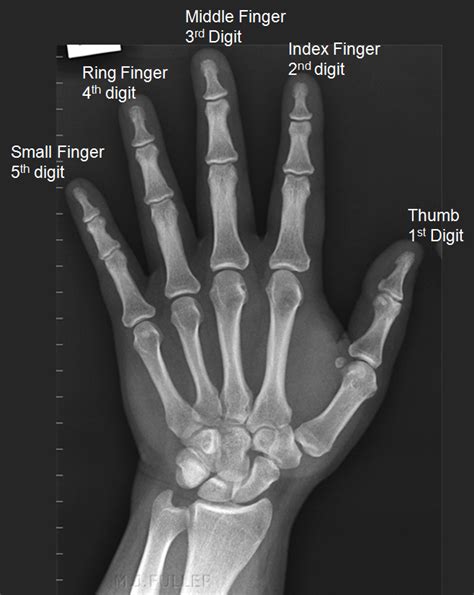 Finger Radiography Wikiradiography