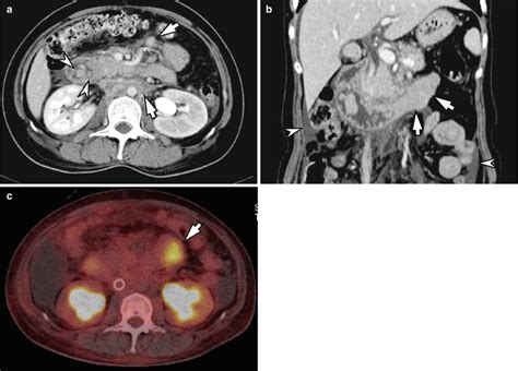 Malignant Tumors Of The Small Bowel Radiology Key