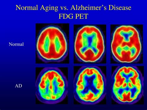 Ppt Alzheimers Disease Neuroimaging Initiative Adni Powerpoint