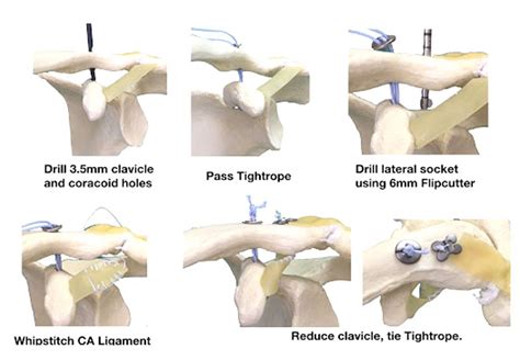 Acromioclavicular Joint Reconstruction Bishop Ac Joint Injuries Ca My