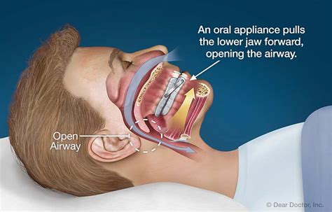 Snoring And Sleep Apnea Doctors Morris And Taylor Ltd Elizabeth City North Carolina