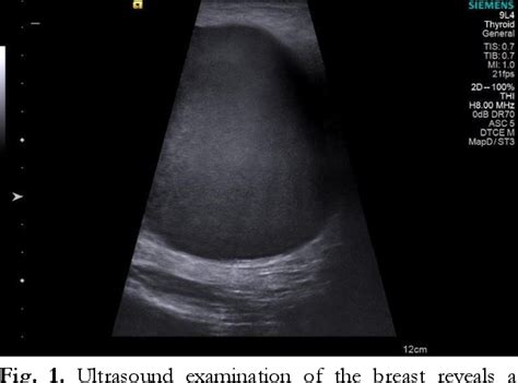 Figure 1 From Evaluation Of Giant Galactocele With Ultrasound And