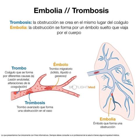 Embolia Trombosis Escuelas De Medicina Practicas De Enfermeria