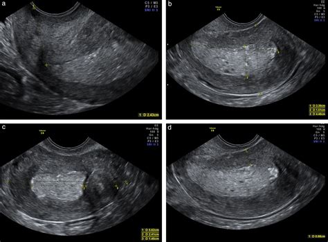Ultrasound Characteristics Of Endometrial Cancer As Defined By