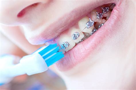 Higiene Dental Seg N Cada Tipo De Ortodoncia
