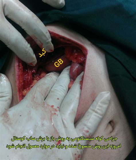 Mar 22, 2019 · gallstones can lead to pain in the upper right abdomen. سنگ کیسه صفرا | جراحان