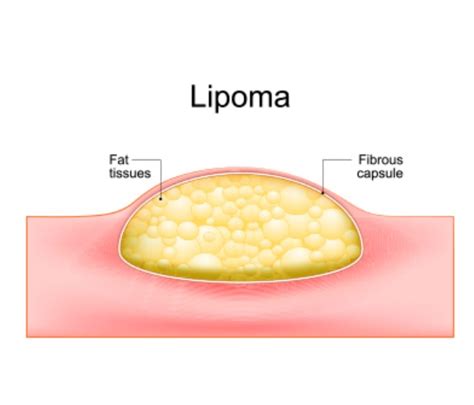 Lipoma Treatment At Home Natural Ways To Remove Fatty Lumps