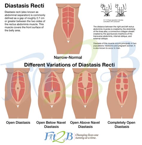 Although diastasis recti often causes no issues and usually resolves on its own, it can cause lower back pain, constipation standing sway back, with your hips and stomach pushing forward and your shoulders slouched, can lead to diastasis recti. How to Prevent and Heal Diastasis Recti - Best Maternity ...