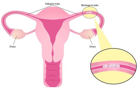 Blocked Fallopian Tubes Causes Treatment And Complications