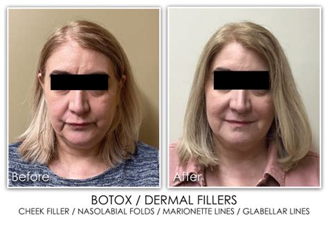14 Botox Dermal Fillers Cheek Nasolabial Folds Marionette Glabellar