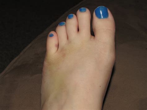 Broken Toe And Bruises Flickr Photo Sharing