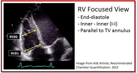 7 Tips To Implementing Rv Size Quantification Cardioserv
