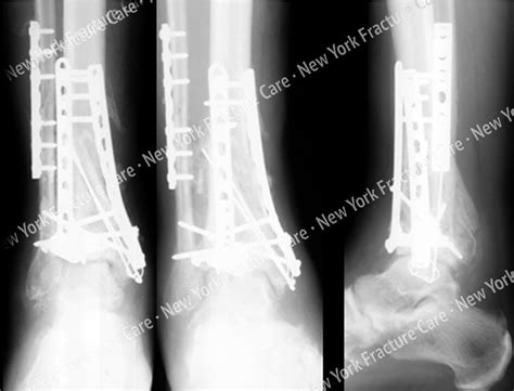 Distal Tibia Pilon Fractures New York Fracture Care