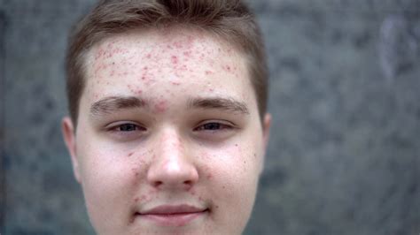 Teenage Boy With Puberty Acne Problem Stock Footage Sbv 324614281