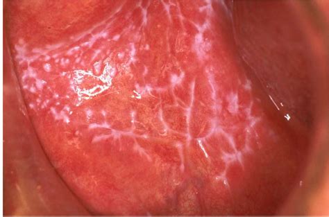 Reticular Oral Lichen Planus Involving The Buccal Mucosa Numerous My