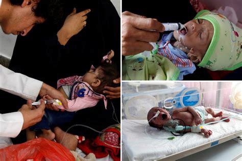 Distressing pics show malnourished kids in Yemen as it's revealed there are 820 million people ...