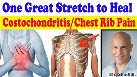 What Is Costochondritis Symptoms Of Costochondritis Stretching My Xxx