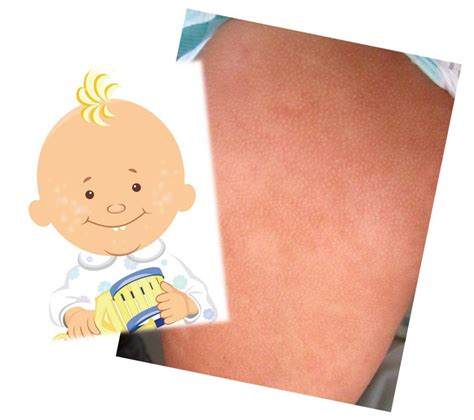 Ofrasalud Manchas Blancas En Niños Con Dermatitis Atópica Por Dra