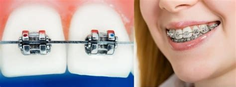 Metal vs ceramics the question of comparing clear or ceramic brackets versus metal braces is … How do braces work? | Ortho3