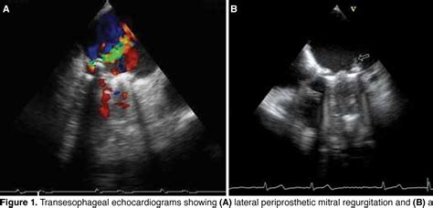 Figure 1 From Hemolysis And Infective Endocarditis In A Mitral