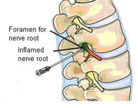 Epidural Nerve Root Block Injection A Personal Experience