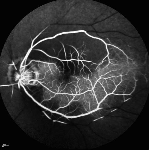 Central Retinal Artery Occlusion With Cilioretinal Sparing Fundus
