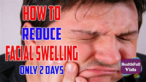 Facial Swelling How To Reduce Facial Swelling In 2 Day Youtube