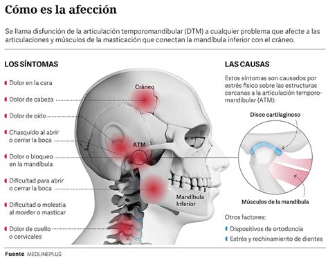 Disfunción de la Articulación Temporomandibular ATM