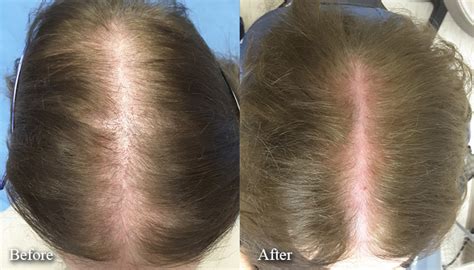 Prp Treatment Before And After Female Limmer Hair Transplant Center