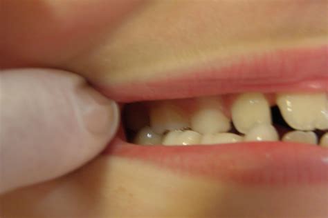 Dental Clinic In Greeceathens Orthodonticsorthodontc Treatment In