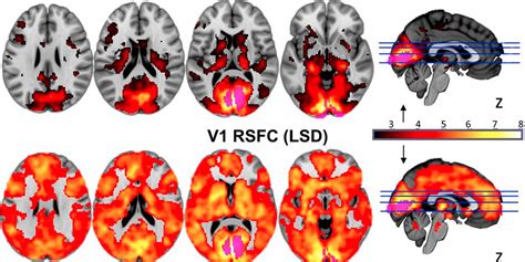 New Images Show How Lsd And Other Psychedelic Drugs Affect The Brain