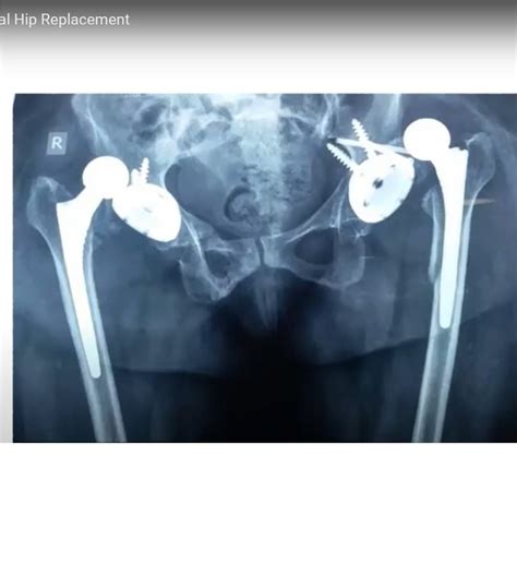 Dislocation After Total Hip Replacement —