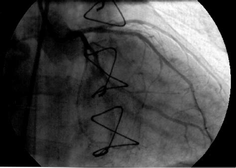 Patient 2 Coronary Angiogram Shows Successful Stent Implantation In