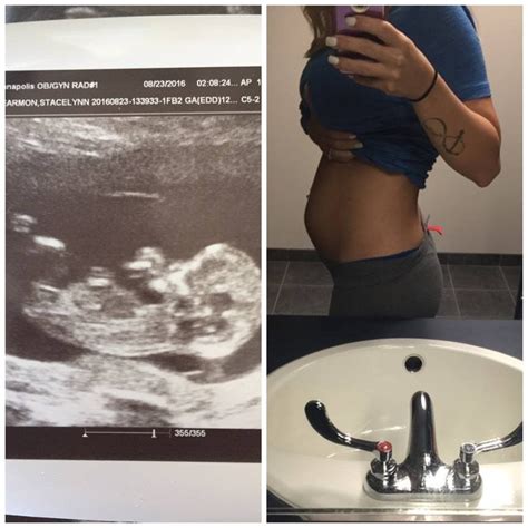 12 Week Bumpdate Nt Scan Fetal Doppler Bellyshot