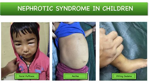 Nephrotic Syndrome In Children Causes Clinical Features