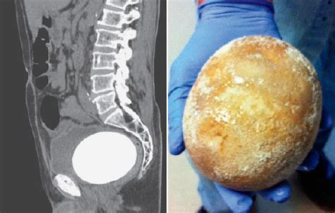 Large Bladder Stone Causes Peeing Problems Mens Health