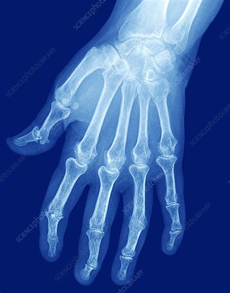 Arthritic Hand X Ray Stock Image C0269058 Science Photo Library