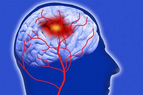 What Are The Telling Symptoms Of An Oncoming Brain Stroke