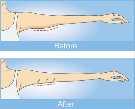 Arm Lift Surgery Recovery And Results Estetica Scottsdale