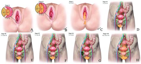 Revised Figo Staging Of Vulvar Cancer Stage I Tumor Confined To