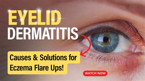 Eyelid Dermatitis Uncovered Causes And Solutions Youtube