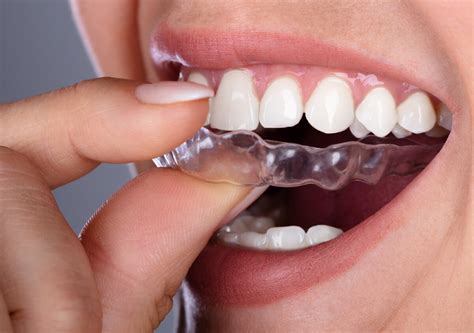 Adult Orthodontics With Invisalign Knoxville Tn Get Straighter Teeth
