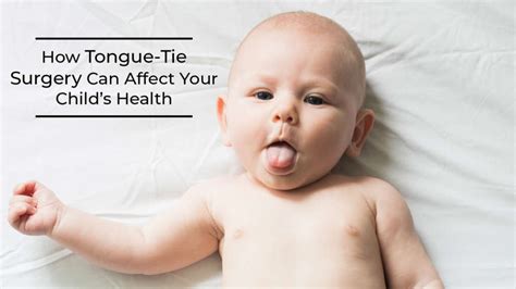 How Tongue Tie Surgery Can Affect Your Childs Health Cloud