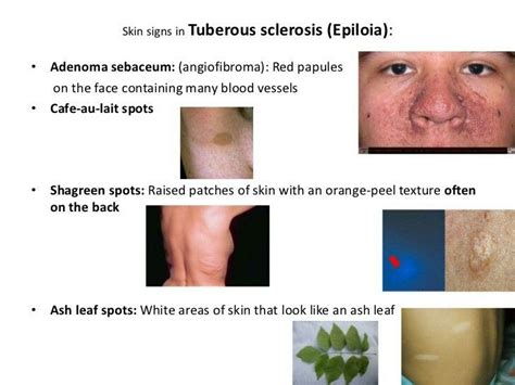 Tuberous Sclerosis Ash Leaf Orange Peel Texture Blood Vessels