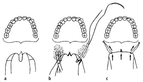 The constricted opening leading from the oral cavity to the oropharynx. (a) Wolford's modified uvulopalatopharyngoplasty procedure ...