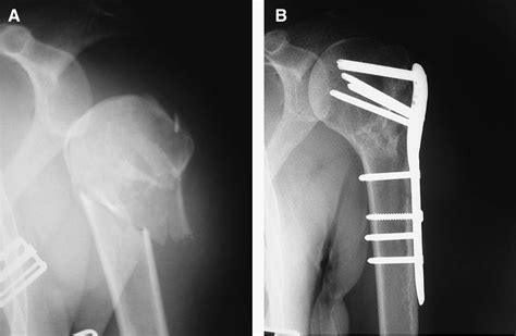 The Results Of Orif Of Displaced Unstable Proximal Humeral Fractures