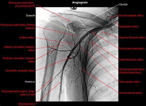 Arteriography Angiogram Of The Axillary Artery And His Branches All