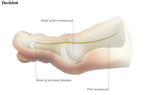 Dorsomedial Approach To Mtp Joint Of Great Toe Approaches Orthobullets